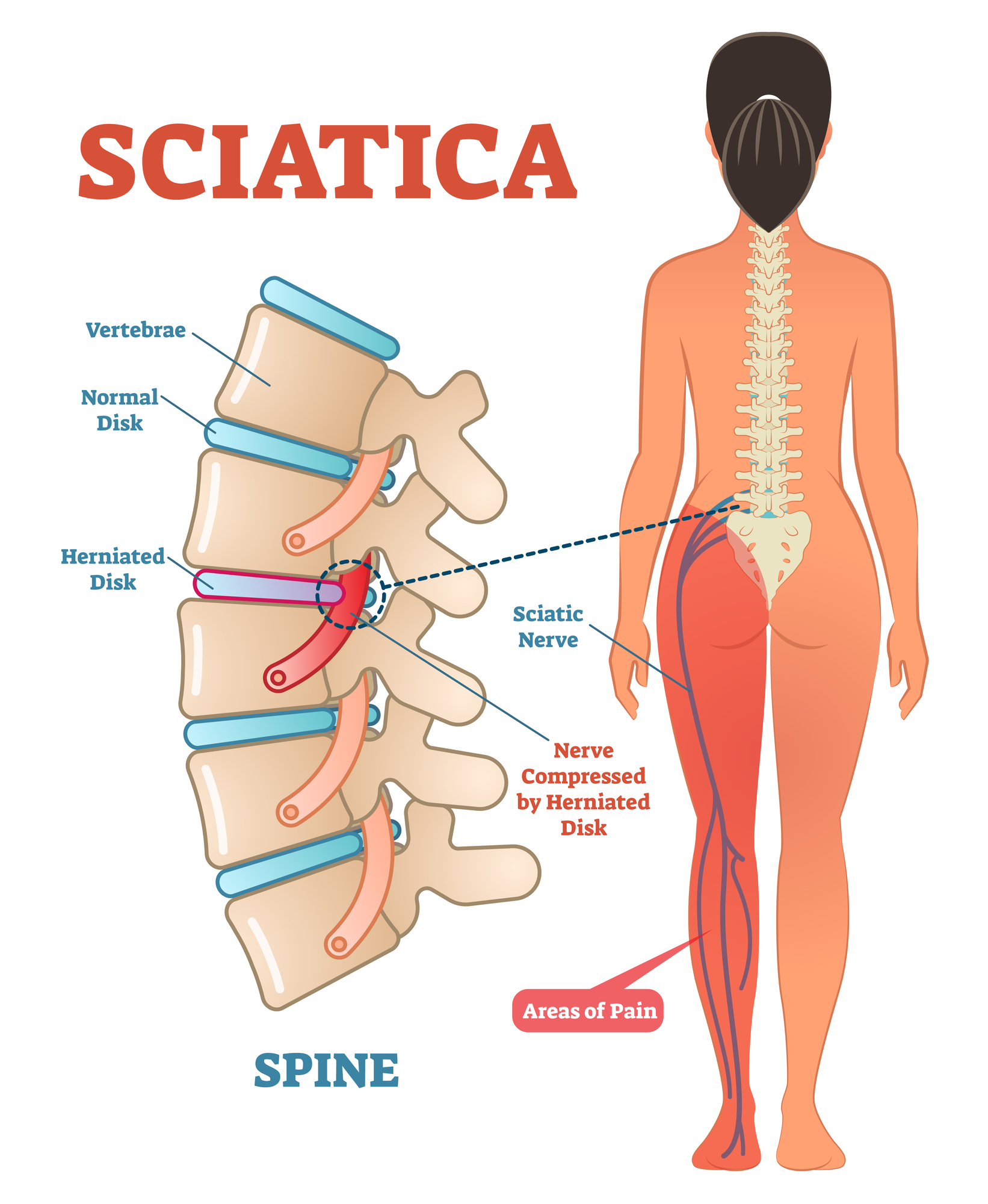 Can Sciatica Affect Your Pelvic Area