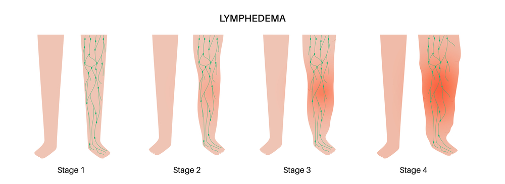lymphedema